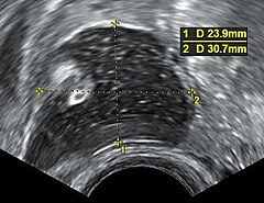 Dermoid cyst