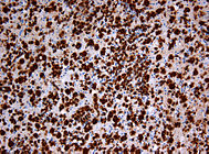 Nachweis zahlreicher Makrophagen (braun gefärbt) in der immunhistochemischen Färbung für CD68. Chromogen Diaminobenzidin, Gegenfärbung mit Hämatoxylin. Vergrößerung 200x.