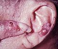 Gouty tophi presenting as nodules on the finger and helix of the ear