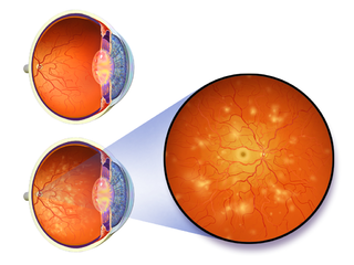 Diabetic retinopathy.