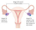 Stage 1 ovarian cancer