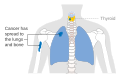 Stage M1 thyroid cancer