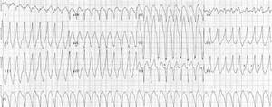 Monomorphic ventricular tachycardia