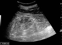 Chronic renal disease caused by glomerulonephritis with increased echogenicity and reduced cortical thickness. Measurement of kidney length on the US image is illustrated by '+' and a dashed line.[57]