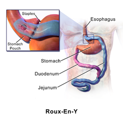 Roux-en-Y anastomosis.