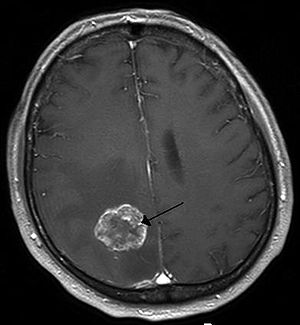 Пухлина головного мозку на знімку МРТ
