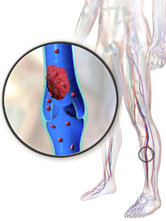 Deep vein thrombosis.