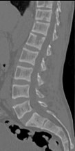 CT scan of the same case.[18]