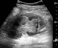 Figure 28. Renal trauma with laceration of the lower pole and subcapsular fluid collection below the kidney.[1]