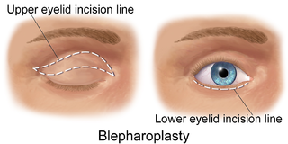 Blepharoplasty.