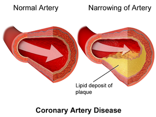 Coronary artery disease.