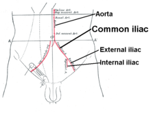 Iliac artery bifurcation and aorta.PNG