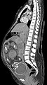 Median plane CT scan of a pregnant woman. The fetus (exposed in the coronal plane) is 37 weeks of gestational age.