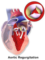 Aortic valve regurgitation