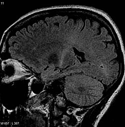 MRI felvétel egy ALS-ben szenvedő beteg agyáról. A capsula interna hátsó részének jelintenzitása fokozott, ami egészen a motoros kéregig követhető.