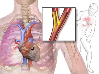 Angina pectoris.