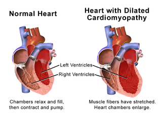 Normal heart versus one with dilated cardiomyopathy