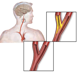 Carotid artery stenosis.