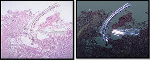 Cellulose contamination, in H&E stain and polarized light