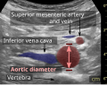 The standard aortic measurement on تخطيط الصدى البطني, such as used for أم الدم الأبهرية البطنيةs, is between the outer margins of the aortic wall.[3]