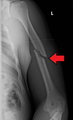 A transverse fracture of the humerus shaft