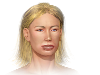 Angioedema.