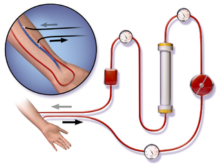 Hemodialysis.