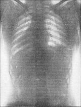 Radiografia del tòrax humà