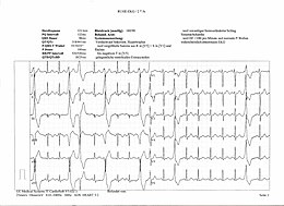 Description de l'image Ekg abnormal bionerd.jpg.