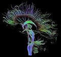 Diffusion tensor imaging of brain