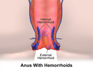 Hemorrhoids.