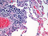 Tecido pulmonar dun paciente con enfisema. Núcleos celulares (púrpuras azulados), glóbulos vermellos (vermello brillante), outros corpos celulares e material extracelular (rosa), e espazos aéreos (brancos).