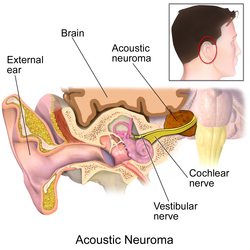 Acoustic neuroma.