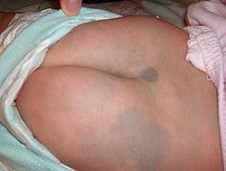 بقعة منغولية ظاهرة في طفل عمره 6 أشهر