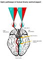 The optic chiasm in the human brain, showing pathways conveying information from the visual field of each eye to the contralateral visual cortex