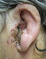 Alvorlig tilfelle av ytre ørebetennelse med betent tragus, innsnevring av den ytre øregangen og puss