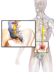 Ankylosing spondylitis.