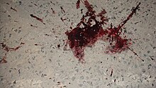 A blood stain