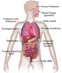 Cystic fibrosis.