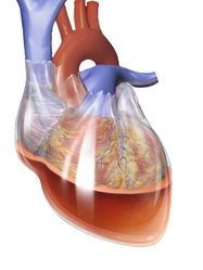 Hemopericardium