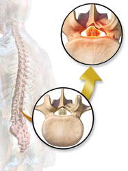 Spinal stenosis.