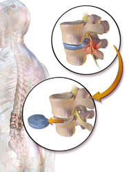 Discectomy.