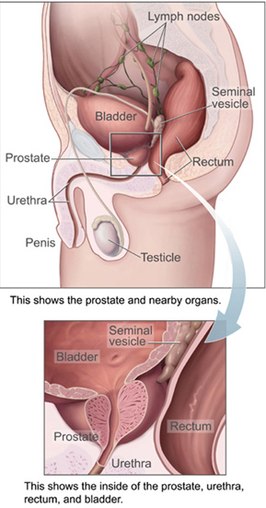 Prostatitis