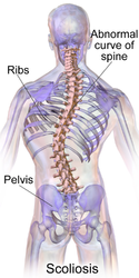 Scoliosis.