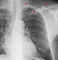 The inferior skin folds of the supraclavicular fossa may give the impression of a periosteal reaction of the clavicle