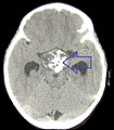 Kraniofaringioma, Bilgisayarlı tomografi görüntüsü.