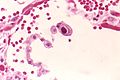 interstitielle Pneumonie (histologisch) bei CMV-Infektion