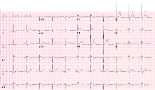 Type 2 Brugada ECG pattern