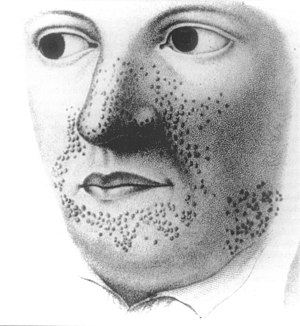 Перша відома ілюстрація захворювання, з атласу шкірних хвороб французького лікаря П'єра Райе, 1835 року.