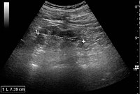 Chronic pyelonephritis with reduced kidney size and focal cortical thinning. Measurement of kidney length on the US image is illustrated by '+' and a dashed line.[57]